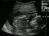 Ultrasound image of our baby
